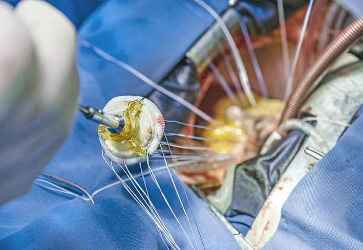 Aortic Valve Replacement tissue valve mechanical valve Dr Levi Bassin surgeon Sydney