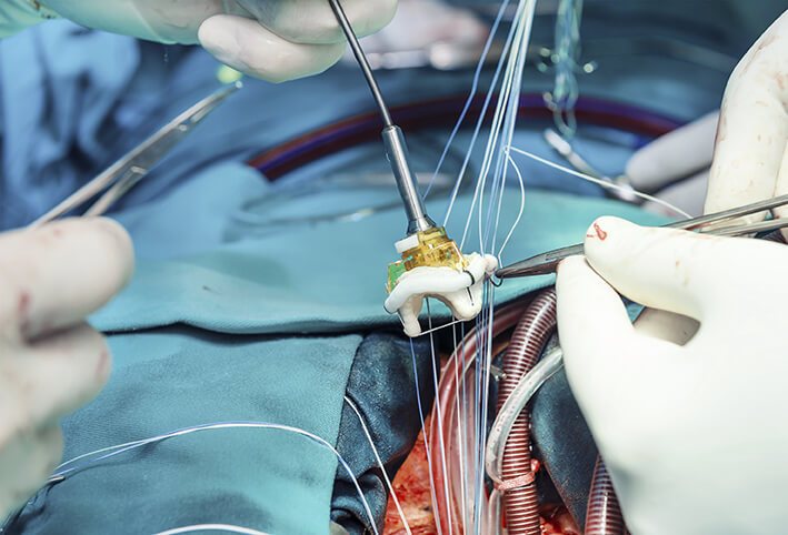 Mitral valve repair expert minimally invasive robotic Dr Levi Bassin surgeon Sydney